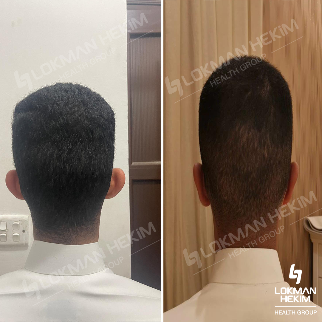 Отопластике (пластике ушей)